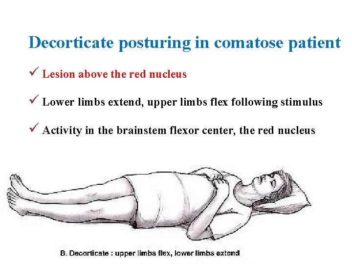 Decorticate posturing in comatose patient Lesion above the red nucleus Lower limbs extend, upper