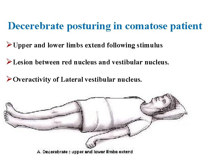 Decerebrate posturing in comatose patient Upper and lower limbs extend following stimulus Lesion between