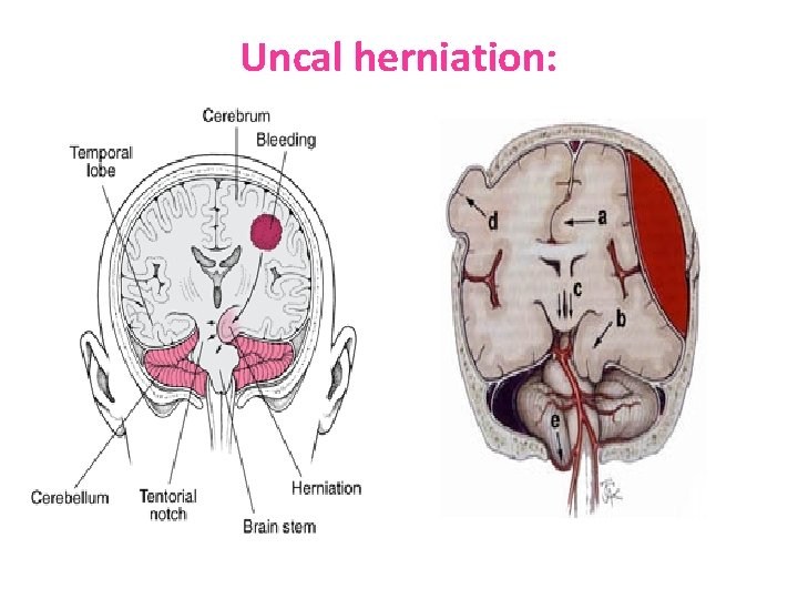 Uncal herniation: 
