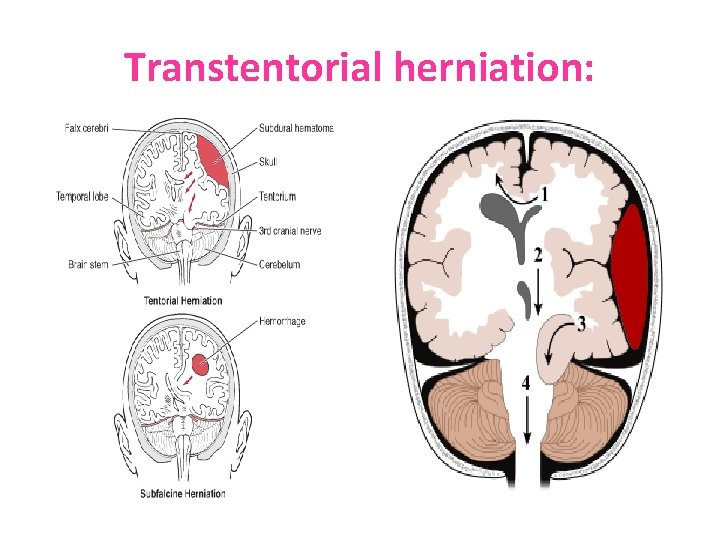 Transtentorial herniation: 