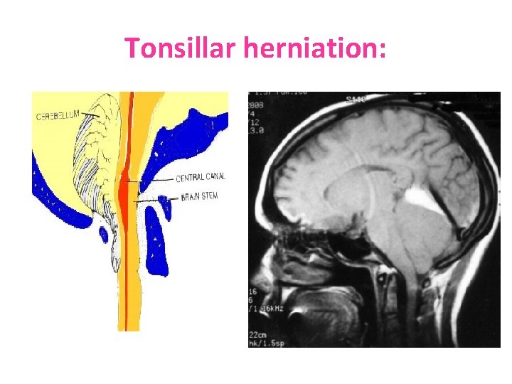 Tonsillar herniation: 
