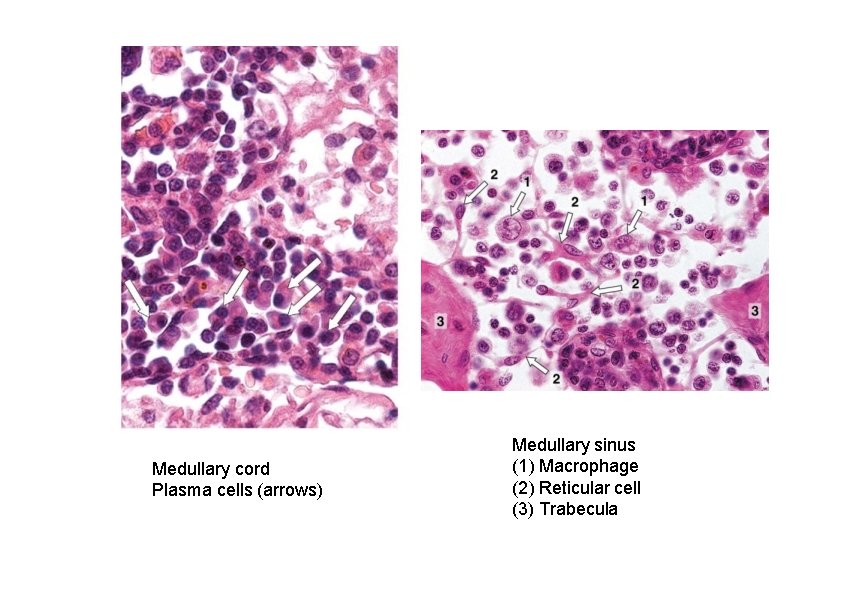 Medullary cord Plasma cells (arrows) Medullary sinus (1) Macrophage (2) Reticular cell (3) Trabecula