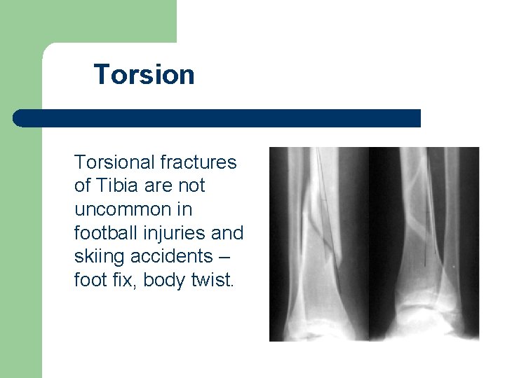 Torsional fractures of Tibia are not uncommon in football injuries and skiing accidents –
