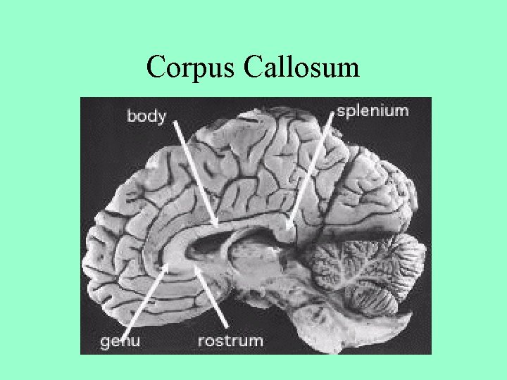 Corpus Callosum 