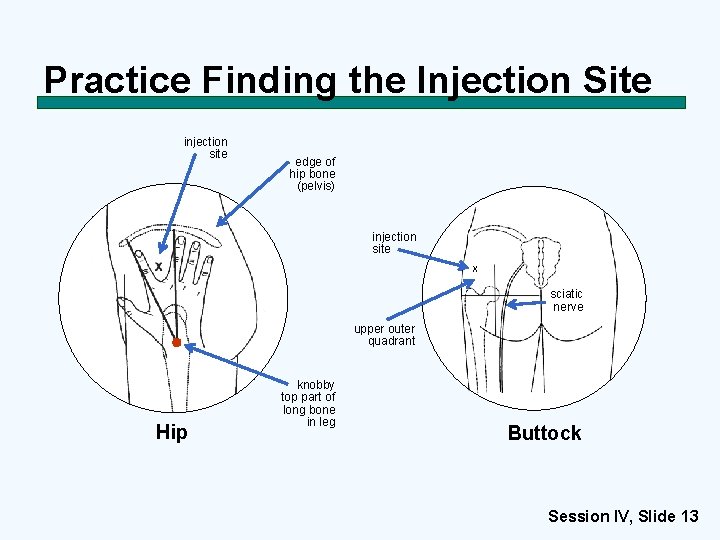 Practice Finding the Injection Site injection site edge of hip bone (pelvis) injection site
