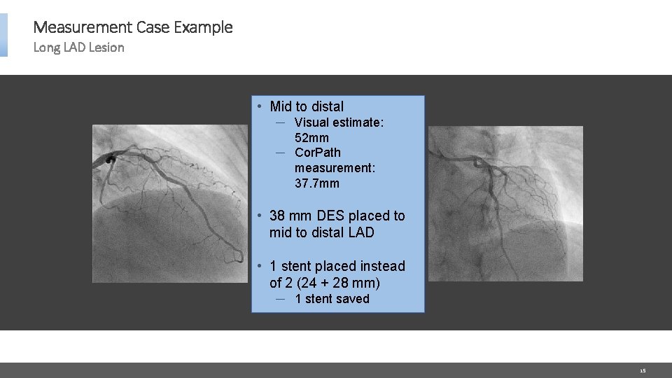 Measurement Case Example Long LAD Lesion • Mid to distal ─ Visual estimate: 52