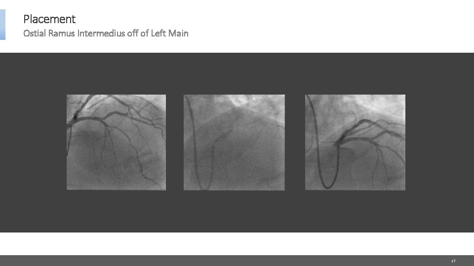 Placement Ostial Ramus Intermedius off of Left Main 17 
