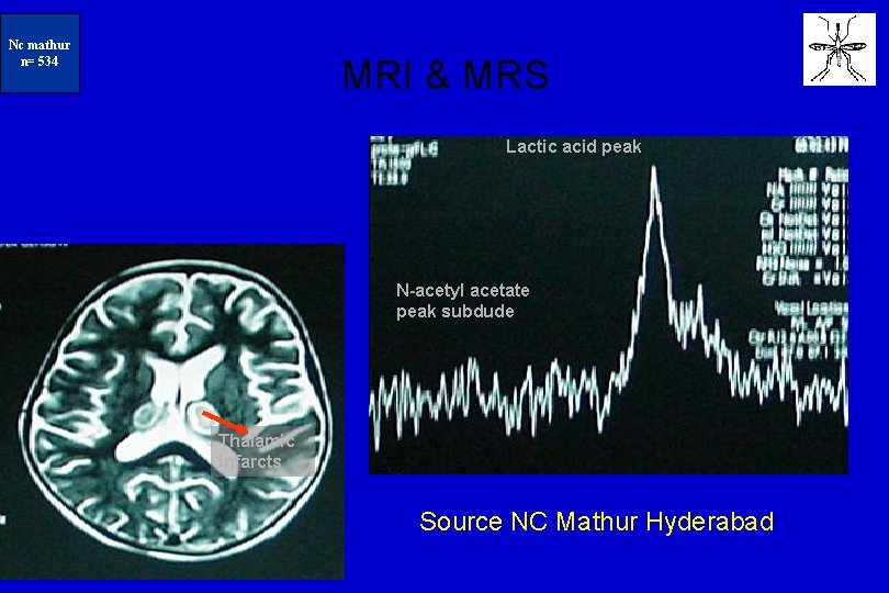 N=234 Nc mathur n= 534 MRI & MRS Lactic acid peak N-acetyl acetate peak