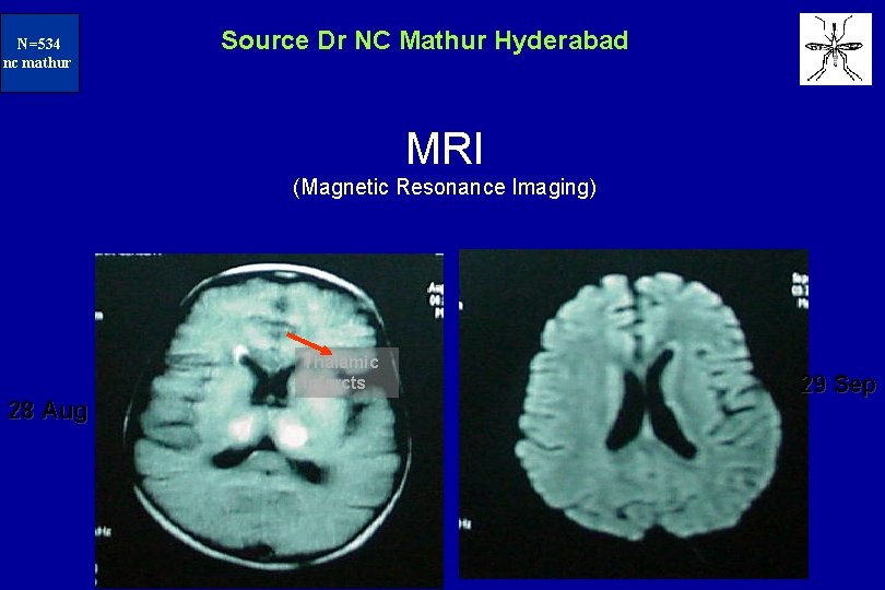 N=234 N=534 nc mathur Source Dr NC Mathur Hyderabad MRI (Magnetic Resonance Imaging) Thalamic