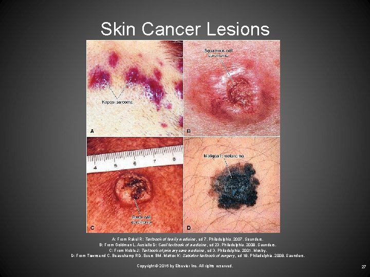 Skin Cancer Lesions A: From Rakel R: Textbook of family medicine, ed 7, Philadelphia,