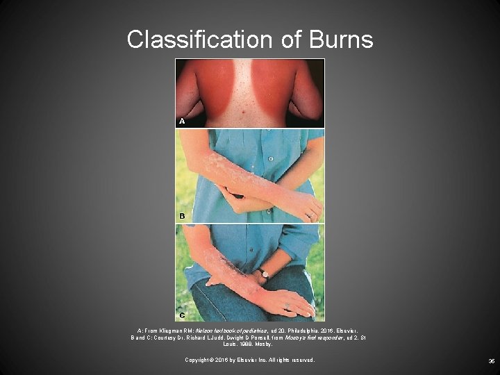 Classification of Burns A: From Kliegman RM: Nelson textbook of pediatrics, ed 20, Philadelphia,