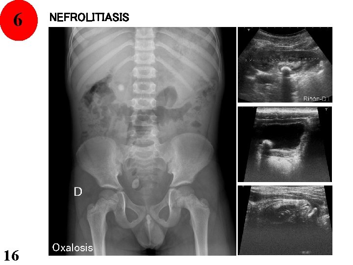 564 16 NEFROLITIASIS Oxalosis 