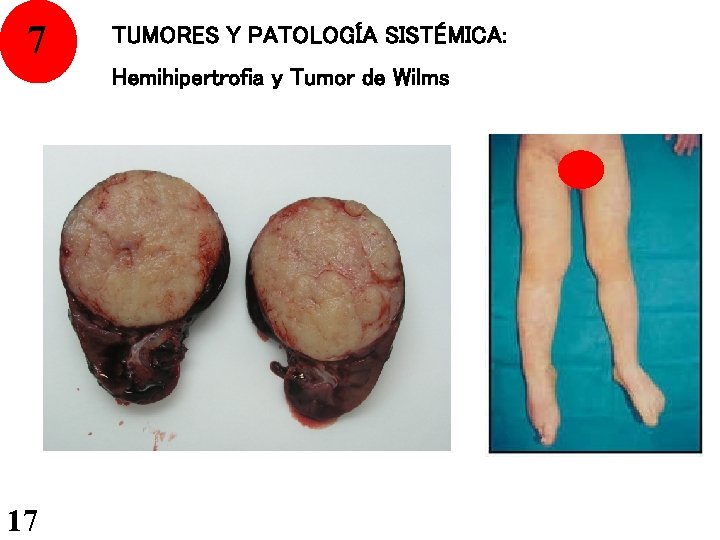 7 TUMORES Y PATOLOGÍA SISTÉMICA: Hemihipertrofia y Tumor de Wilms 17 