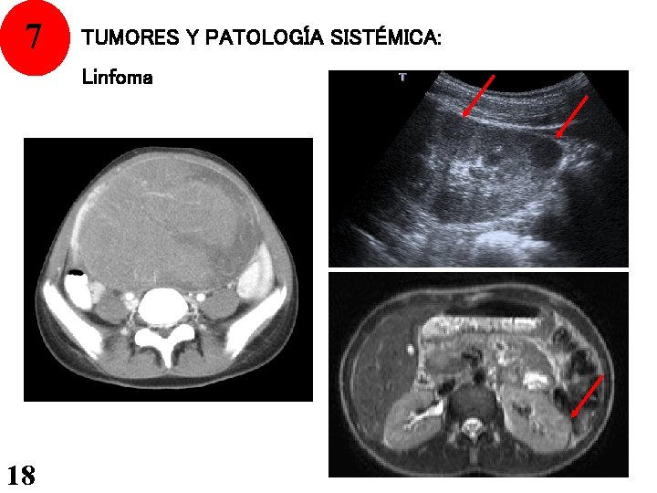 7 TUMORES Y PATOLOGÍA SISTÉMICA: Linfoma 18 