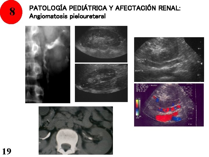 8 19 PATOLOGÍA PEDIÁTRICA Y AFECTACIÓN RENAL: Angiomatosis pieloureteral 