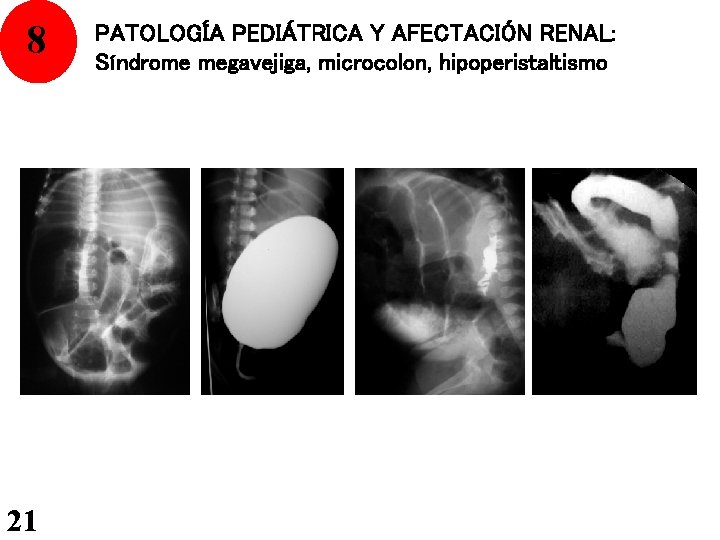 8 21 PATOLOGÍA PEDIÁTRICA Y AFECTACIÓN RENAL: Síndrome megavejiga, microcolon, hipoperistaltismo 