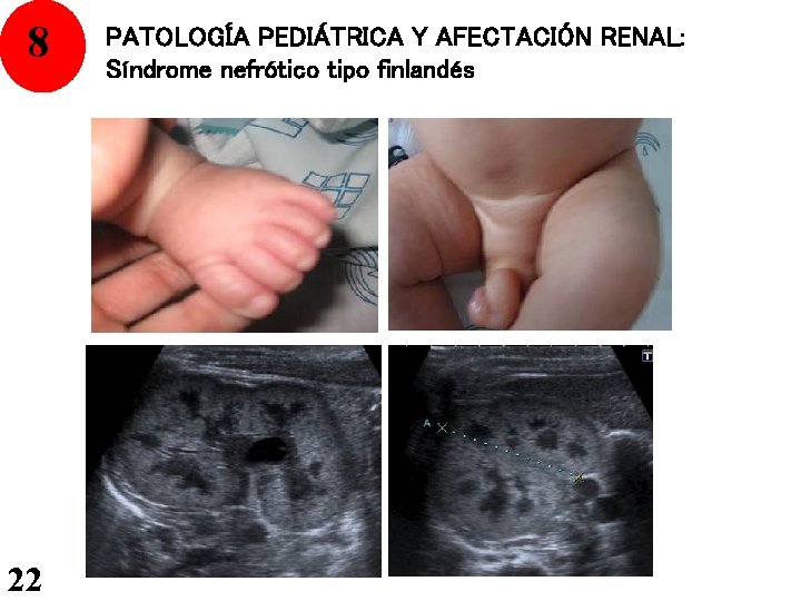 8 22 PATOLOGÍA PEDIÁTRICA Y AFECTACIÓN RENAL: Síndrome nefrótico tipo finlandés 