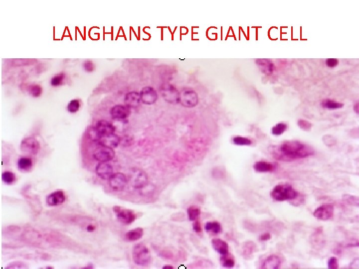 LANGHANS TYPE GIANT CELL 