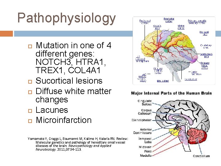 Pathophysiology Mutation in one of 4 different genes: NOTCH 3, HTRA 1, TREX 1,