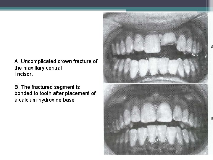 A, Uncomplicated crown fracture of the maxillary central i ncisor. B, The fractured segment