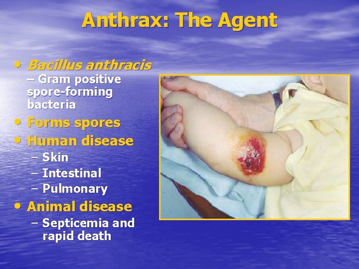 Anthrax: The Agent • Bacillus anthracis – Gram positive spore-forming bacteria • Forms spores