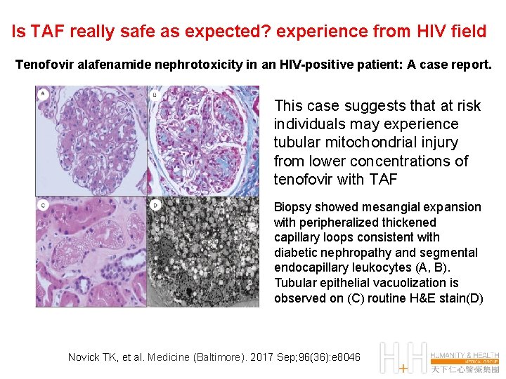 Is TAF really safe as expected? experience from HIV field Tenofovir alafenamide nephrotoxicity in