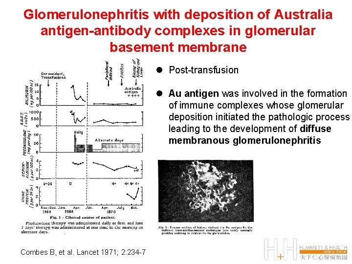 Glomerulonephritis with deposition of Australia antigen-antibody complexes in glomerular basement membrane l Post-transfusion l