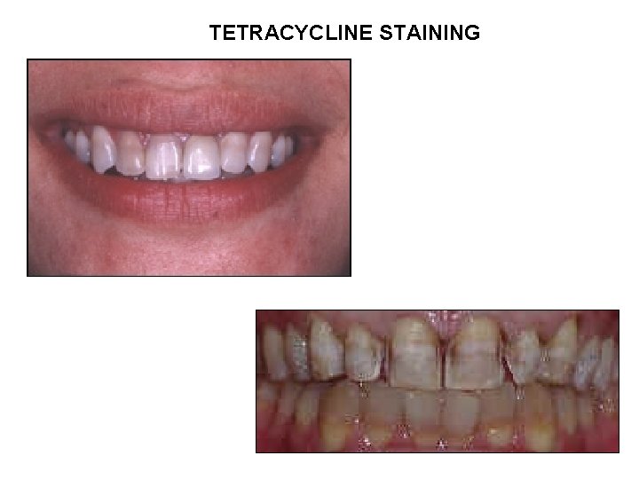 tetracyclines-history-v-v-obtained-from-soil-actinomyces
