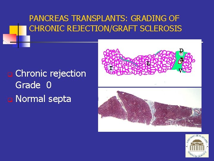 PANCREAS TRANSPLANTS: GRADING OF CHRONIC REJECTION/GRAFT SCLEROSIS Chronic rejection Grade 0 q Normal septa