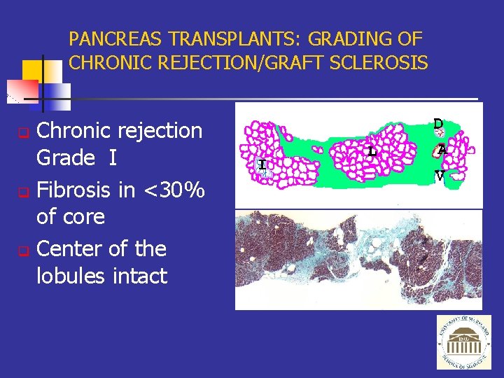 PANCREAS TRANSPLANTS: GRADING OF CHRONIC REJECTION/GRAFT SCLEROSIS Chronic rejection Grade I q Fibrosis in