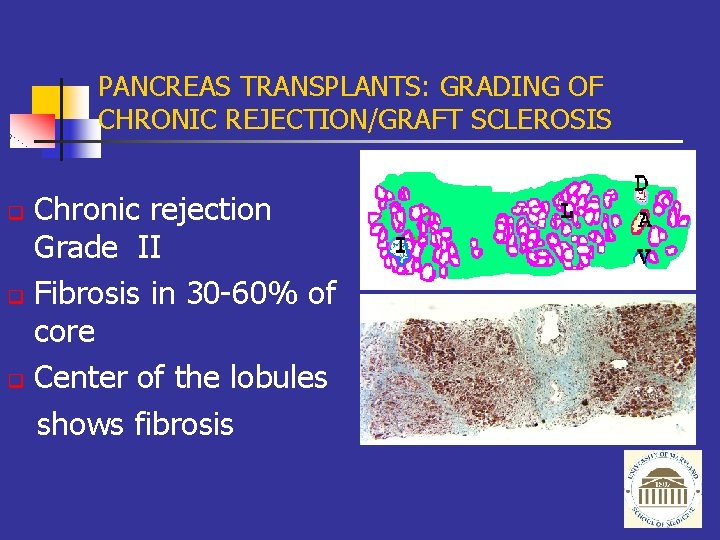 PANCREAS TRANSPLANTS: GRADING OF CHRONIC REJECTION/GRAFT SCLEROSIS Chronic rejection Grade II q Fibrosis in