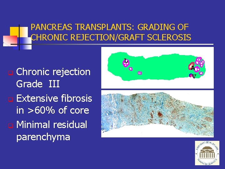 PANCREAS TRANSPLANTS: GRADING OF CHRONIC REJECTION/GRAFT SCLEROSIS Chronic rejection Grade III q Extensive fibrosis