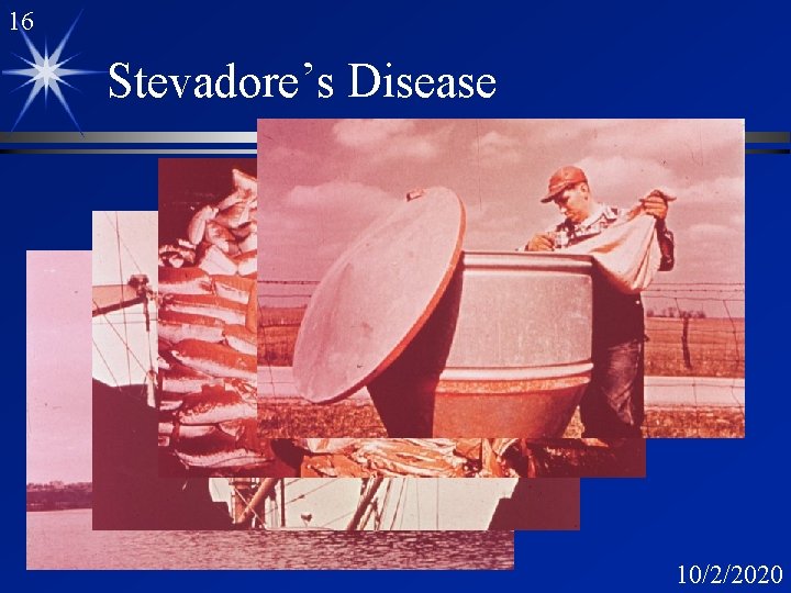 16 Stevadore’s Disease 10/2/2020 