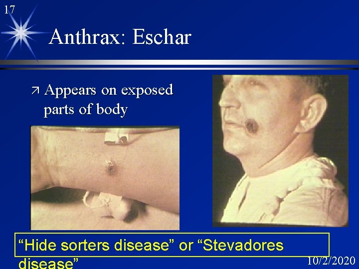 17 Anthrax: Eschar ä Appears on exposed parts of body “Hide sorters disease” or