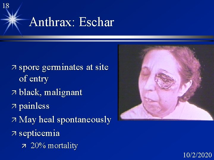 18 Anthrax: Eschar ä spore germinates at site of entry ä black, malignant ä