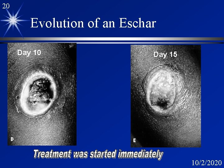 20 Evolution of an Eschar Day 10 Day 15 10/2/2020 
