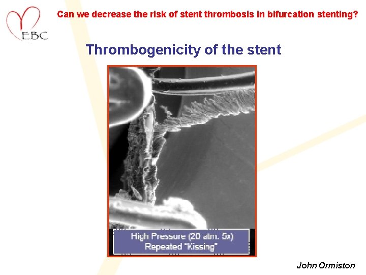 Can we decrease the risk of stent thrombosis in bifurcation stenting? Thrombogenicity of the