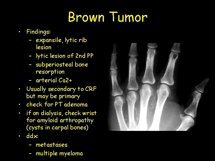 Brown Tumor • Findings: – expansile, lytic rib lesion – lytic lesion of 2