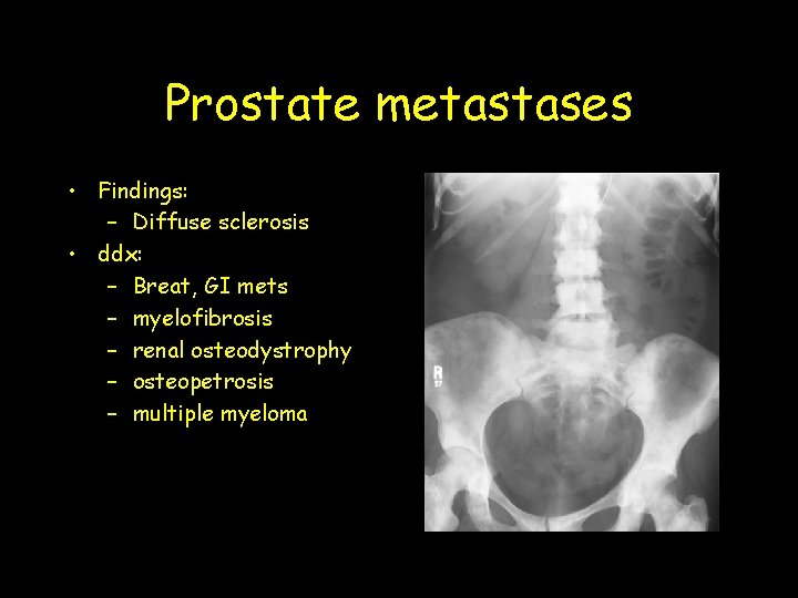 Prostate metastases • Findings: – Diffuse sclerosis • ddx: – Breat, GI mets –