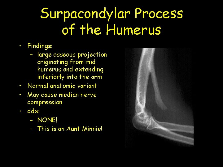 Surpacondylar Process of the Humerus • Findings: – large osseous projection originating from mid
