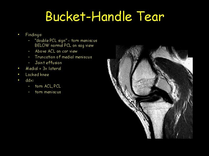 Bucket-Handle Tear • • Findings: – “double PCL sign” - torn meniscus BELOW normal