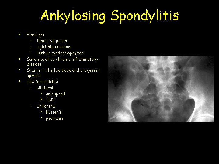 Ankylosing Spondylitis • • Findings: – fused SI joints – right hip erosions –