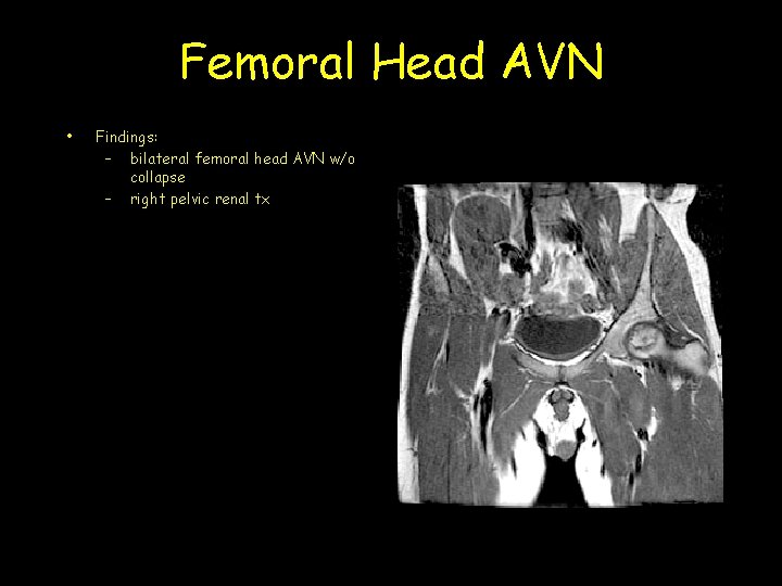 Femoral Head AVN • Findings: – bilateral femoral head AVN w/o collapse – right
