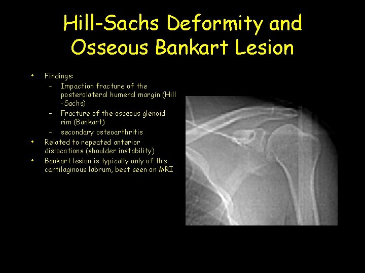 Hill-Sachs Deformity and Osseous Bankart Lesion • • • Findings: – Impaction fracture of