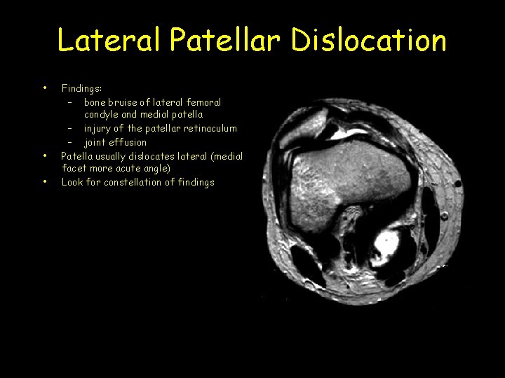 Lateral Patellar Dislocation • • • Findings: – bone bruise of lateral femoral condyle