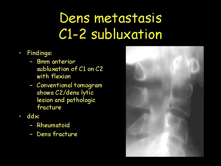 Dens metastasis C 1 -2 subluxation • Findings: – 8 mm anterior subluxation of