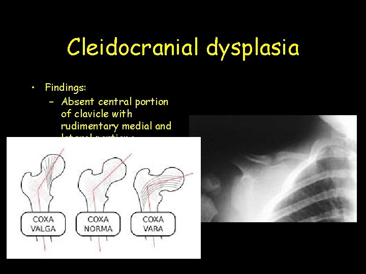 Cleidocranial dysplasia • Findings: – Absent central portion of clavicle with rudimentary medial and