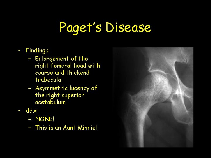 Paget’s Disease • Findings: – Enlargement of the right femoral head with course and
