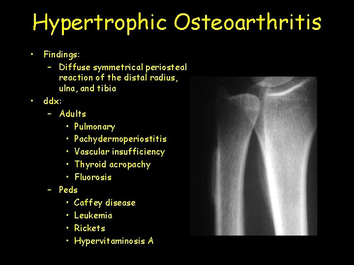 Hypertrophic Osteoarthritis • • Findings: – Diffuse symmetrical periosteal reaction of the distal radius,