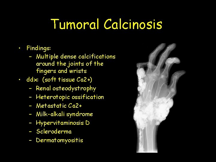 Tumoral Calcinosis • Findings: – Multiple dense calcifications around the joints of the fingers